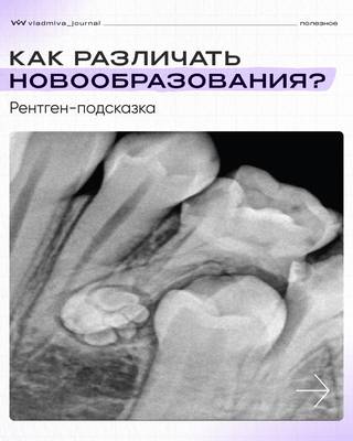 Дифференциальная диагностика новообразований на КТ-снимках.